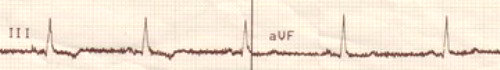 Symbolbild Krankheit (EKG) Symbolbild Krankheit (EKG)